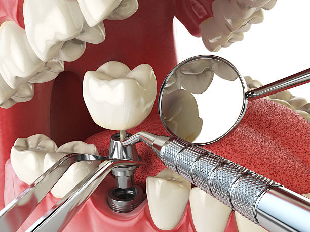 Best Emergency Tooth Extraction in Idyllwild Pine Cove, CA
